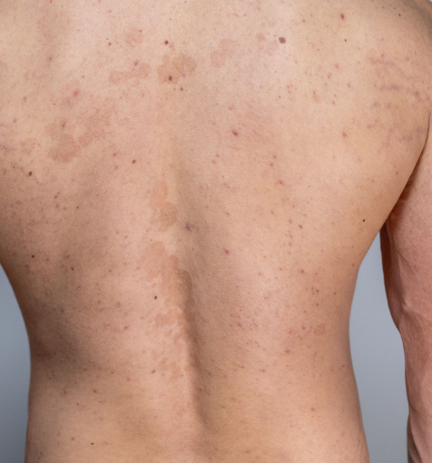 glutathione tinea versicolor In our environment, fungal infections are extremely common among individuals who spend a lot of time at the beach. Pityriasis often presents as uneven pigmentation and is frequently mistaken for vitiligo Tinea Versicolor: Causes, Symptoms &